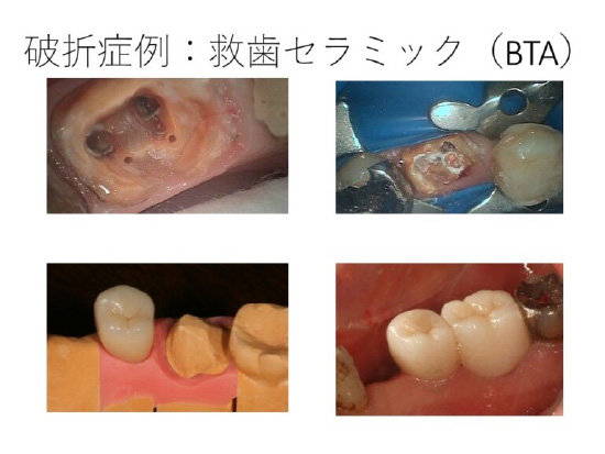 ＢＴＡテクニック