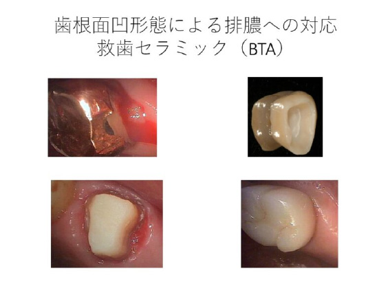 ＢＴＡテクニック