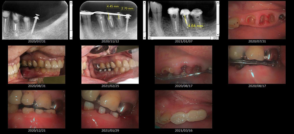MTMを使用した治療画像