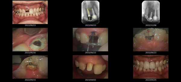MTMを使用した治療画像
