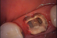 古い詰め物・被せ物・歯の土台等を取り除いた歯