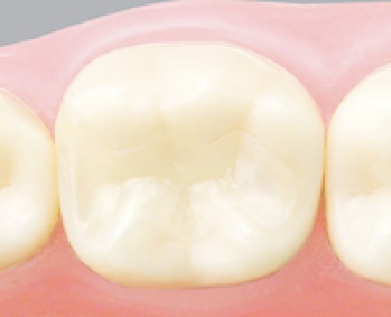 ハイクオリティーオールセラミック(e-MAX)