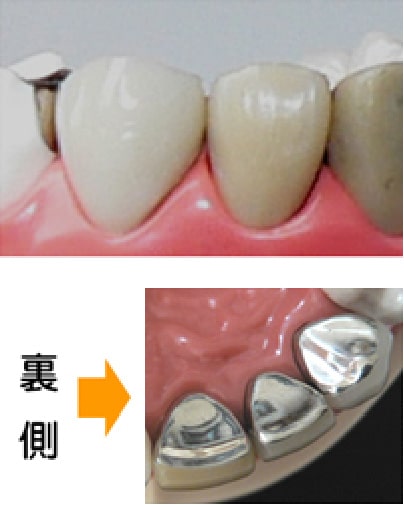 プラスチック前装冠
