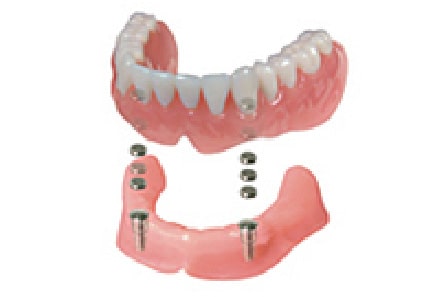 磁性アタッチメント（維持装置）