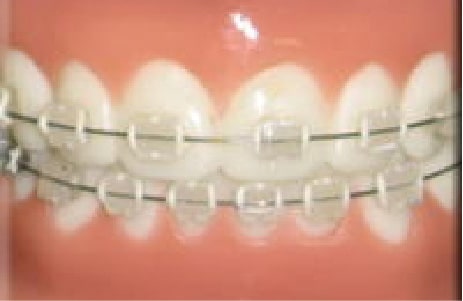 基本矯正料（第2段階:成人）透明ブラケット