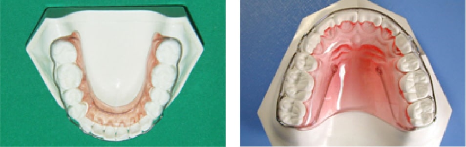 処置調整料（装置をつけている間、来院毎）