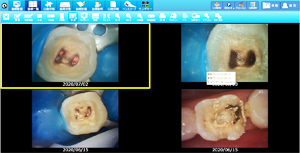 ラバーダムを使用した治療画像