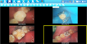 ラバーダムを使用した治療画像