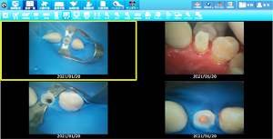 ラバーダムを使用した治療画像
