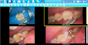 ラバーダムを使用した治療画像