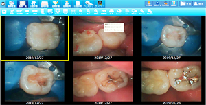 ラバーダムを使用した治療画像