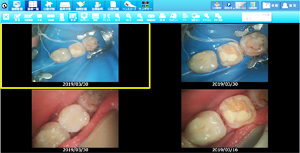 ラバーダムを使用した治療画像