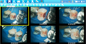 ラバーダムを使用した治療画像