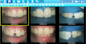 ラバーダムを使用した治療画像