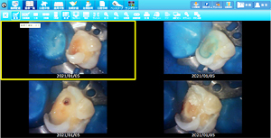 ラバーダムを使用した治療画像