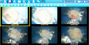 ラバーダムを使用した治療画像